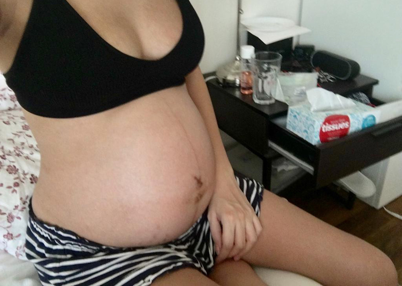 An incompetent cervix – the start of everything that went wrong with my pregnancy