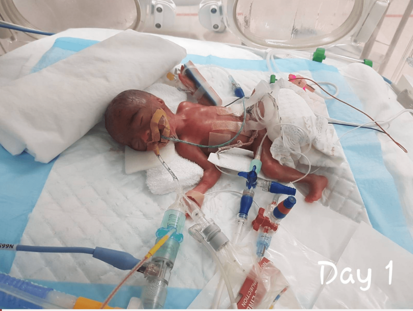 smallest preemie singapore rohani mustani
