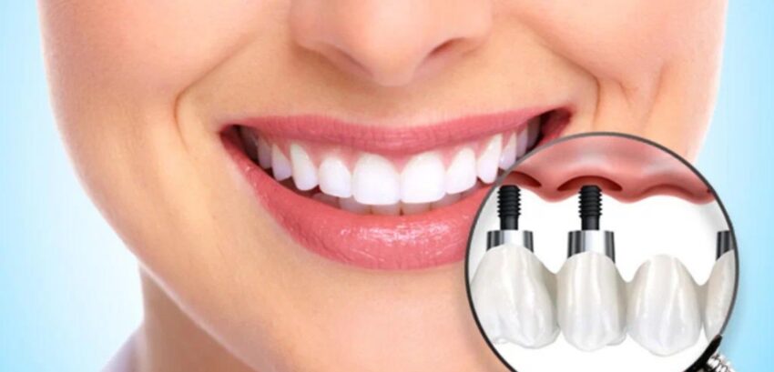 smile with dental implants