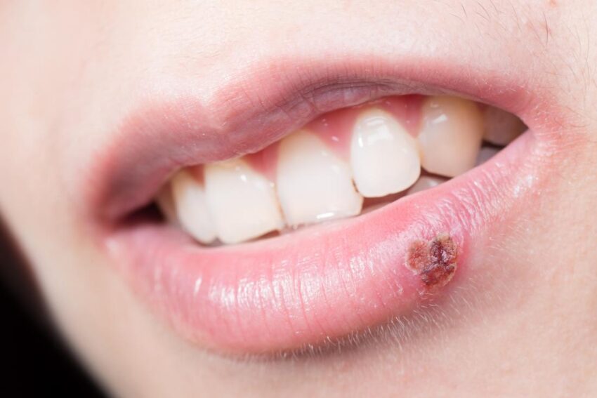 cold sore patches