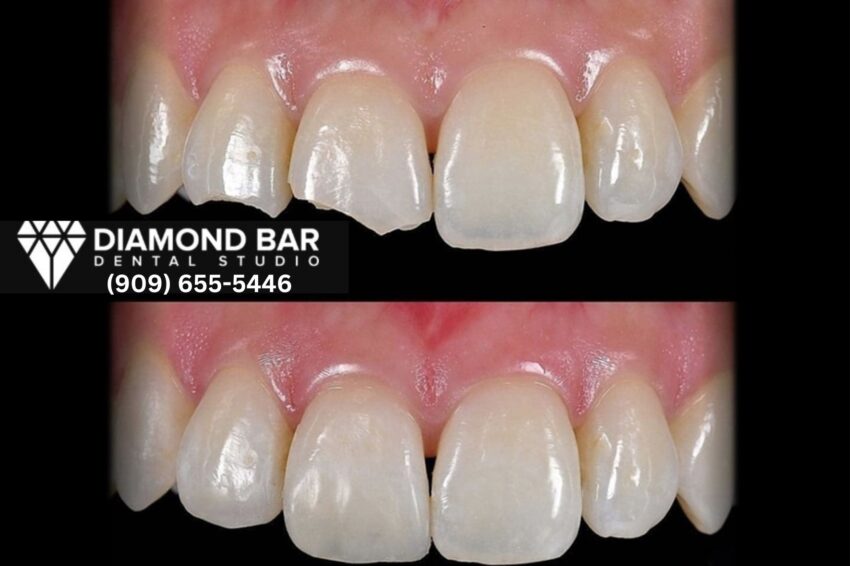 dental bonding Diamond Bar