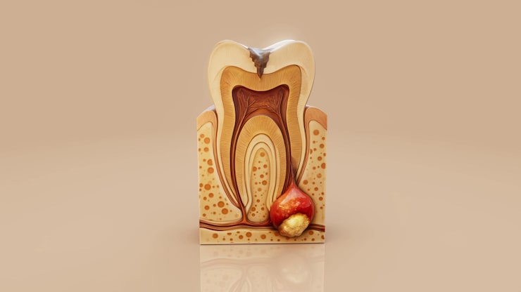 conceptual 3d illustration dental abscess with pus infection 183364 123700