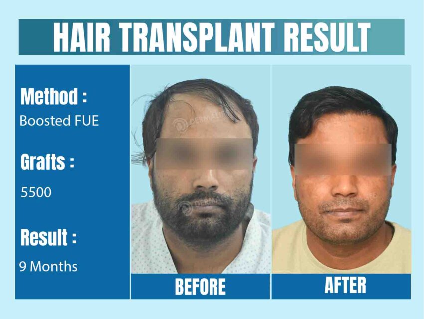 Hair Transplant Before After Result