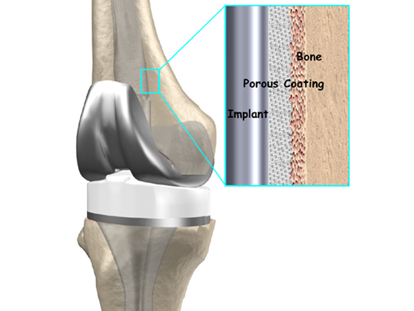 Revision total knee replacement