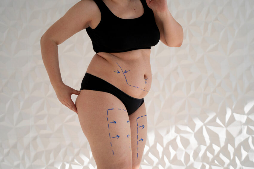 Liposuction in Riyadh cost