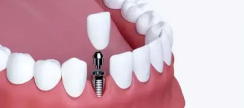Who Needs to Know Single Tooth Implant Cost in Dubai