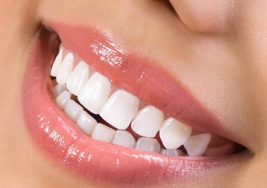 Can Teeth Whitening Help With Discoloratio