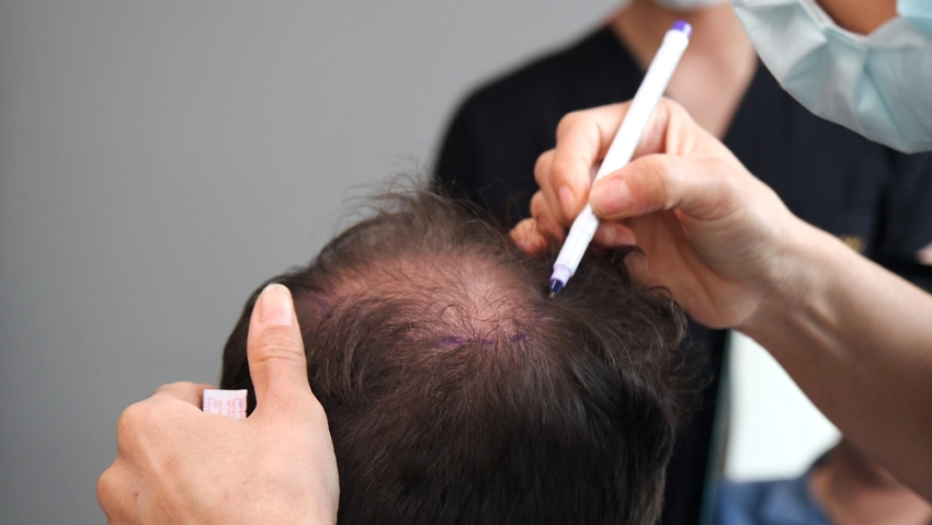 Does Crown Hair Transplant Give a Fuller Hair Appearance