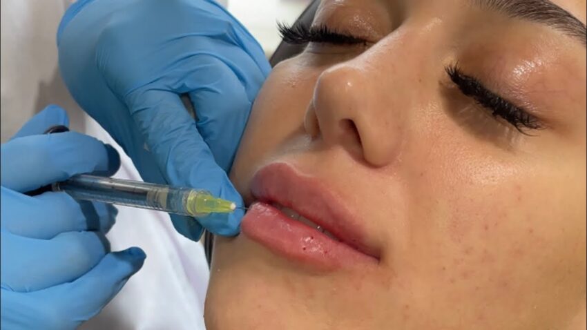 Is Lip Flip the Quick Fix for Thin or Flat Lip