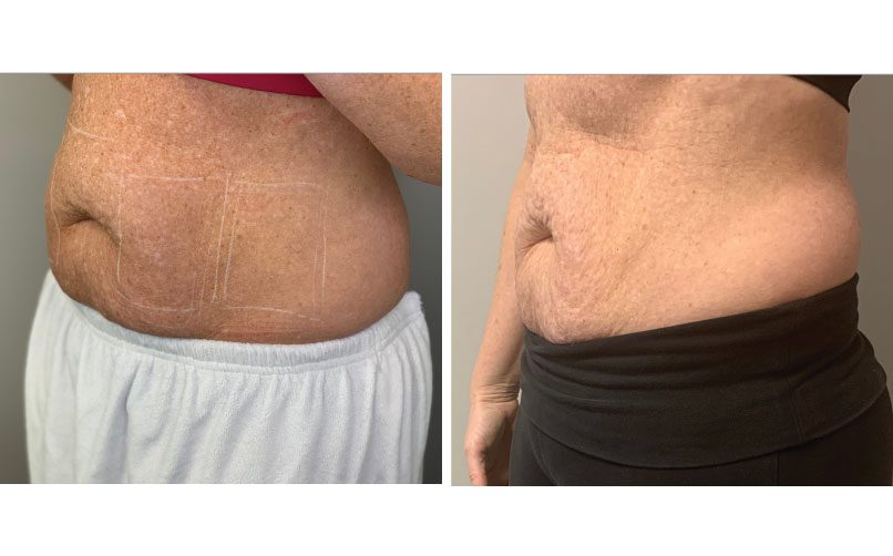 Transformations After Laser Liposuction Realistic
