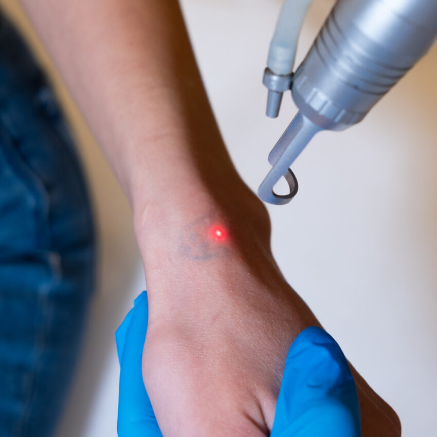 How Does Laser Tattoo Removal Affect Sensitive Skin Area