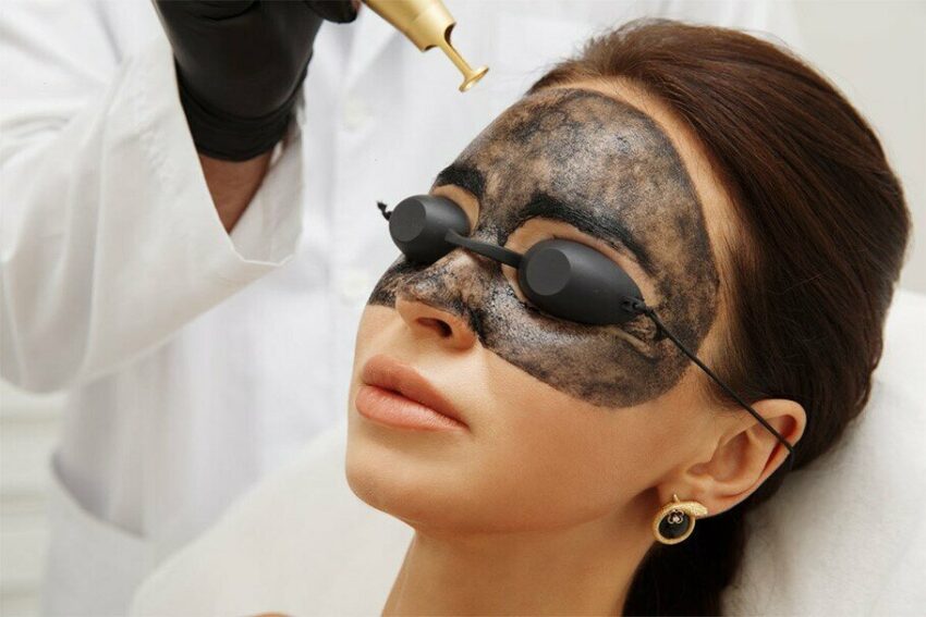 Will Laser Carbon Peel Brighten Skin Without Harsh Peels or Chemical