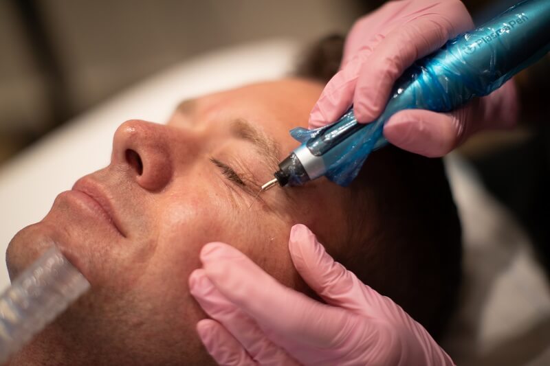 Can Plasma Pen Treatment Improve Skin