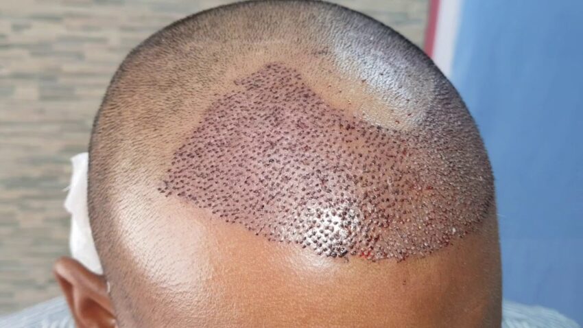 Can Hair Transplant Improve Confidence After Hair Loss