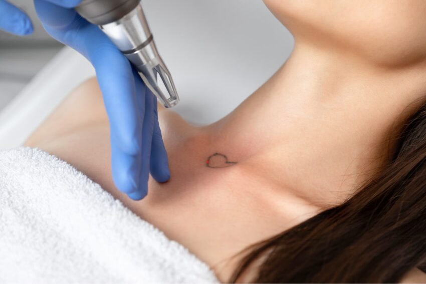 Can Laser Tattoo Removal Cause Skin Discoloration