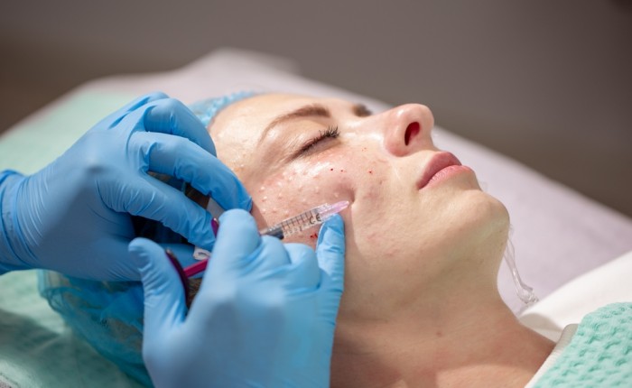 Can a Vampire Facial smooth rough skin