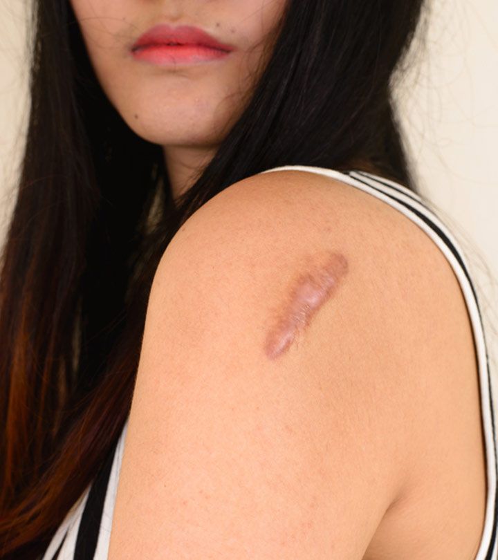 How Does Keloid Treatment Support Proper Scar Management