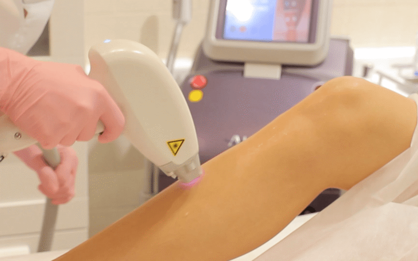 Can Laser Hair Removal Reduce Hair Growth
