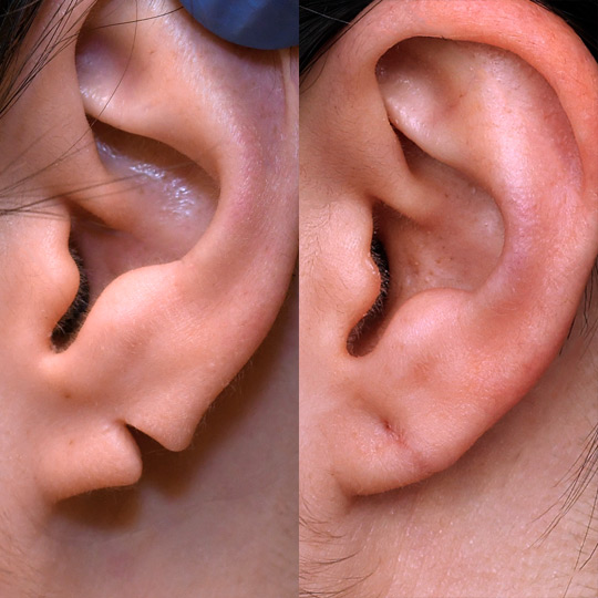696fd978a2aa510291bbf7a1 DrK BA Gallery CTA earlobe repair b
