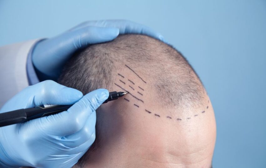 Can Hair Transplant Improve Confidence After Hair Loss 1