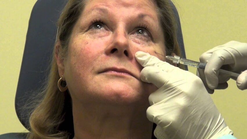 Why Is Under Eye Filler Treatment Used for Tired Eye Appearance