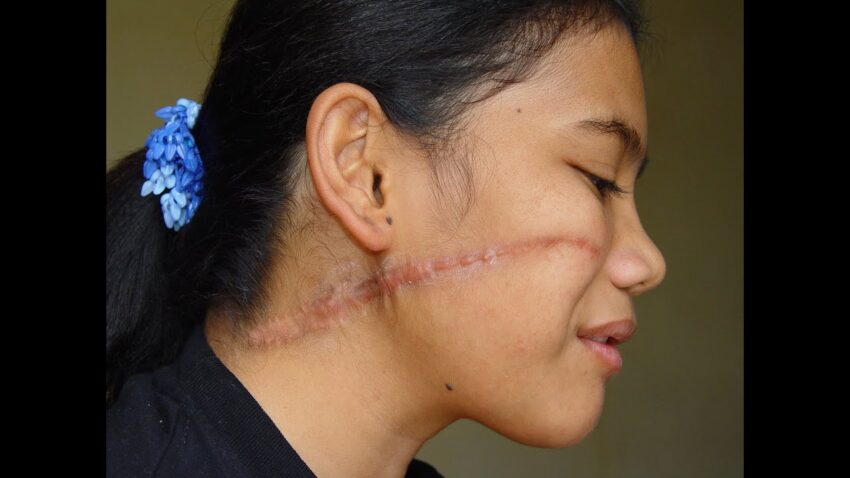 How Does Scar Removal Work on Different Skin Layers