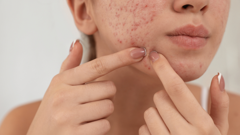 When Do Pimples Treatment Results Become Clearly Visible