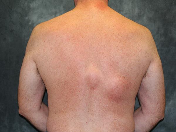 Lipoma Treatment Cost What to Expect Before Treatment