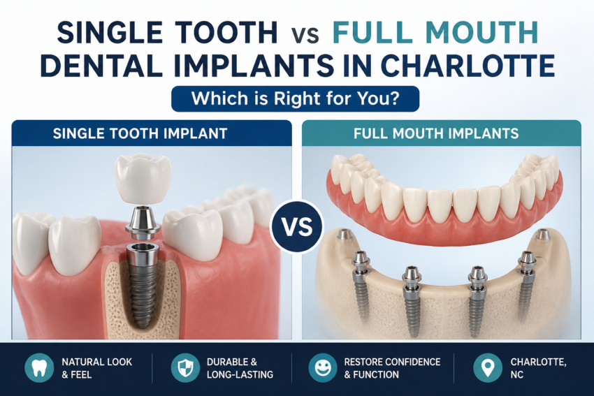 Single Tooth vs Full Mouth Dental Implants in Charlotte Which is Right for You