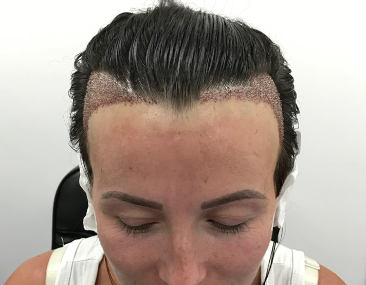 Can Hair Transplant Bring Back Natural Hair Growth