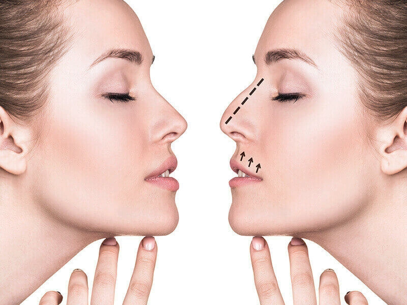 Non Surgical Rhinoplasty and Facial Harmony