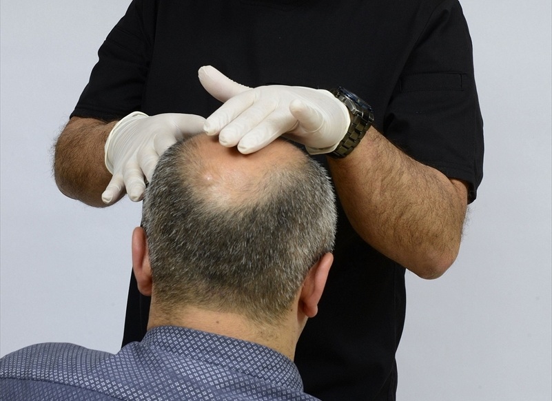 How Does Hair Growth Progress After Crown Transplant Surgery