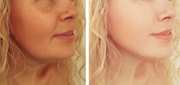 Double Chin Liposuction in Riyadh 1