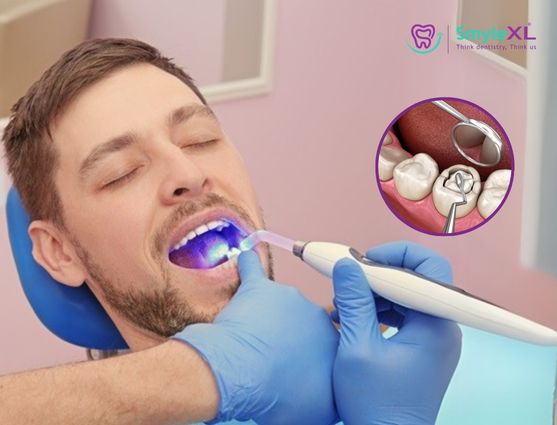 Dental Fillings Treatment