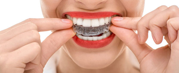 invisalign