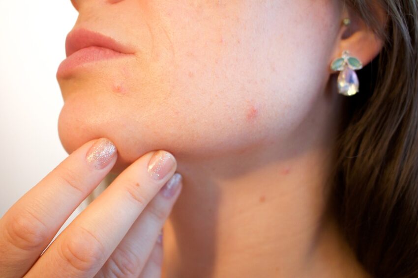 Can the Best Acne Treatment Remove Severe Acne Effectively