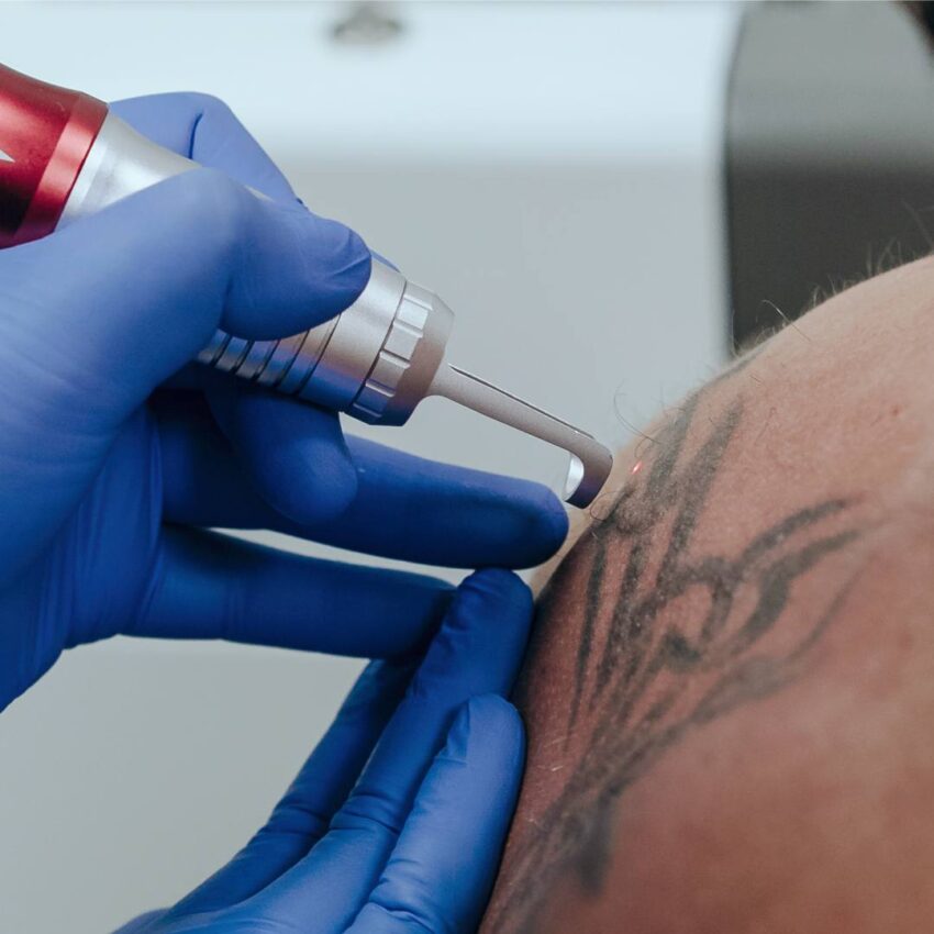 Can Laser Tattoo Removal Dissolve Stubborn Tattoo Ink