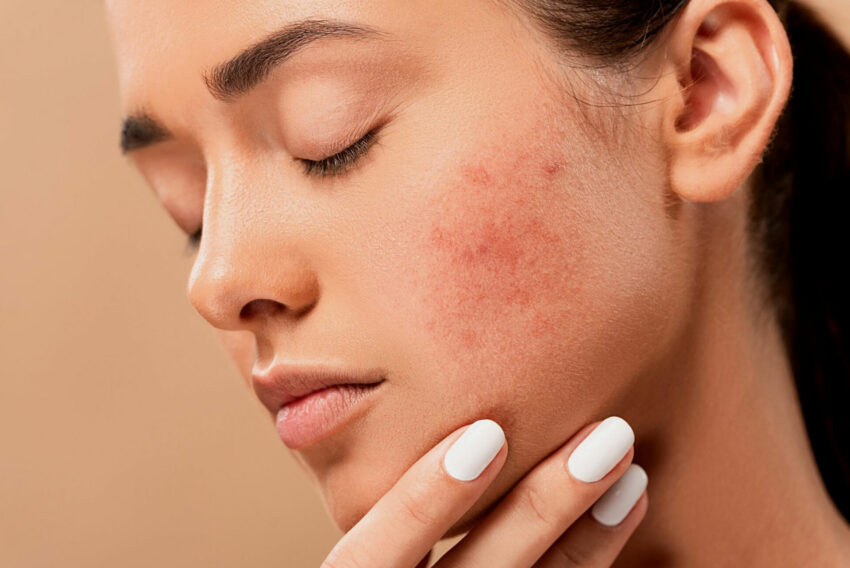 How Does Pimples Treatment Improve Skin Texture Naturally