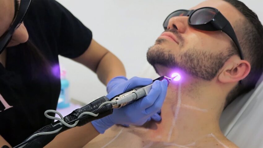 How Does Laser Hair Removal Help Men Reduce Body Hair