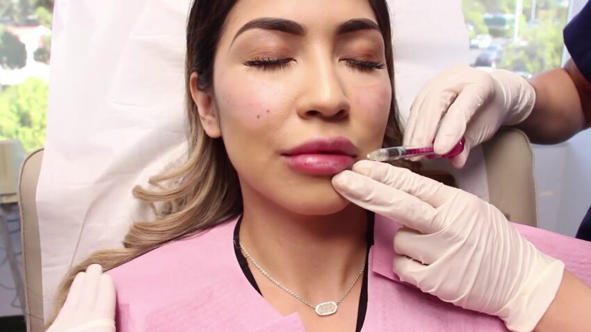 What Should You Expect After Best Lip Fillers Injection
