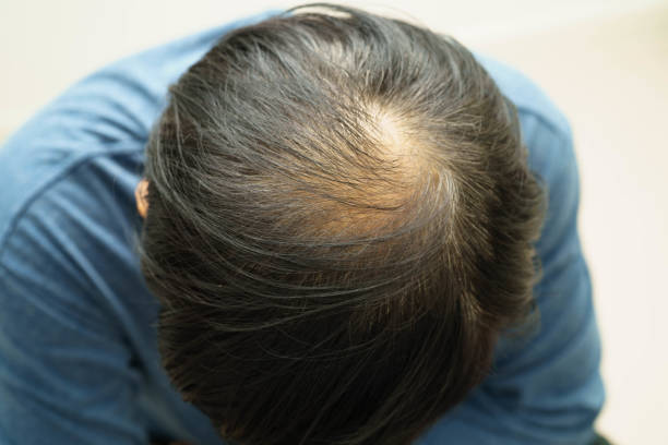 Exosomes Therapy for Hair Loss in Riyadh 8
