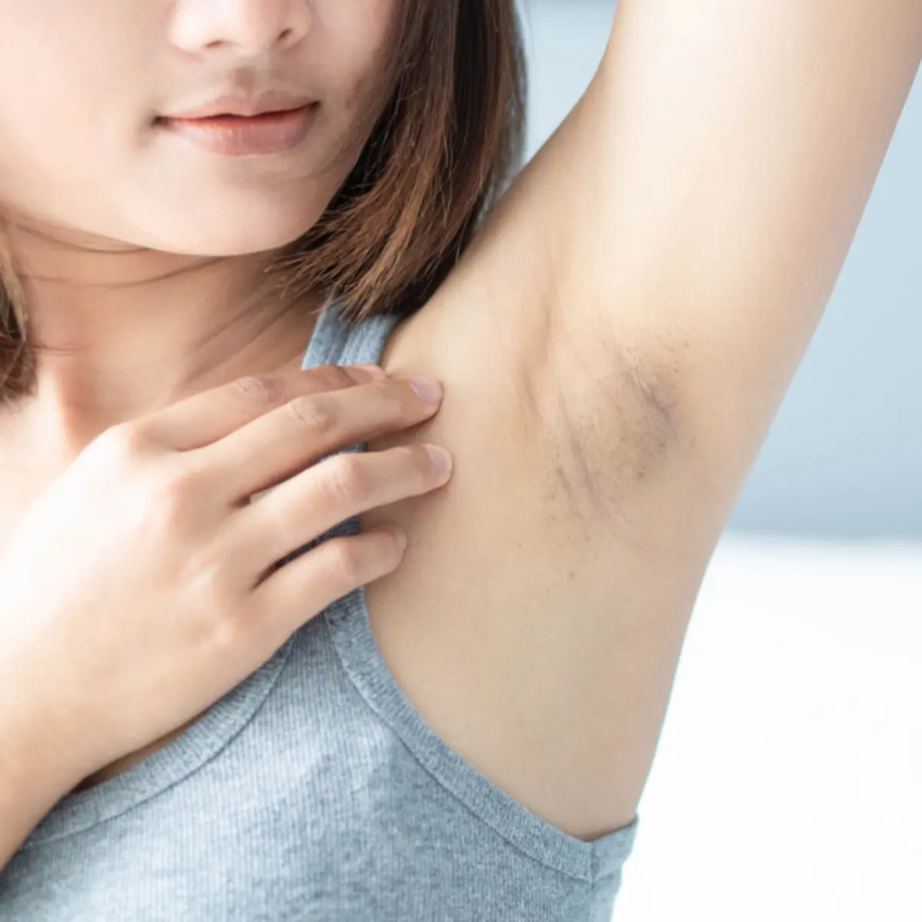 Can Chemical Peels for Dark Underarms Lighten Skin Tone