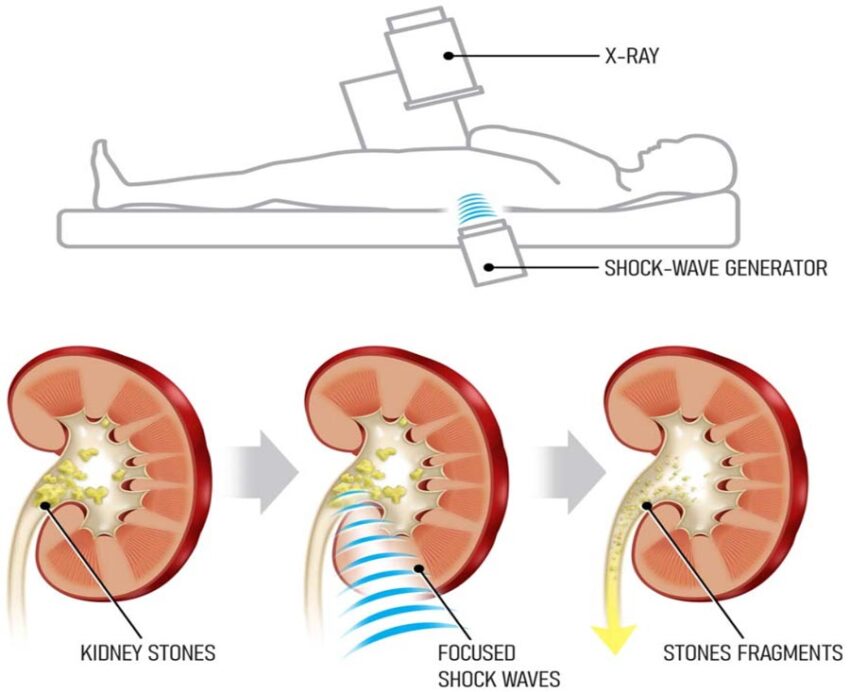 Extracorporeal Shock Wave Lithotripsy
