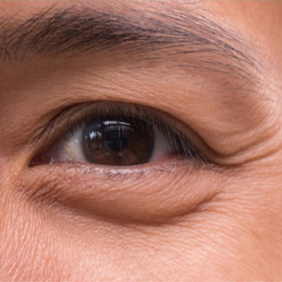 Eye Bag Removal for Mild vs Severe Cases