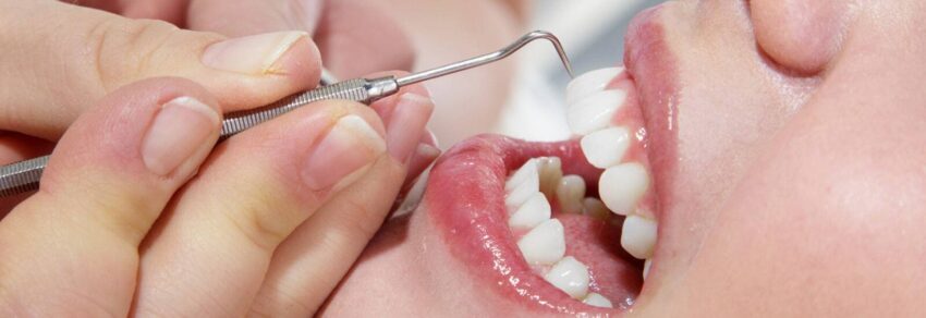 Quality Teeth Cleaning 1