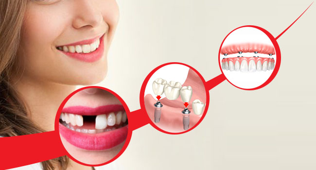 missing tooth treatment