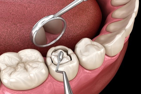 cavity filling