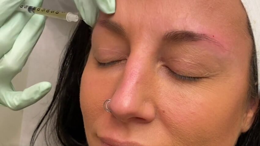Can Forehead Botox Prevent Deep Wrinkle Formation