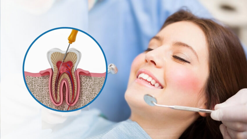 Root Canal