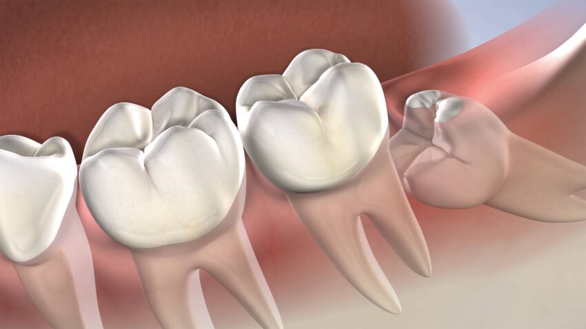 procedure wisdom teeth